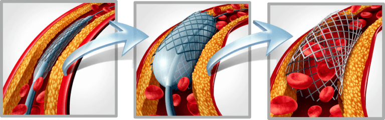 Implantacion stent