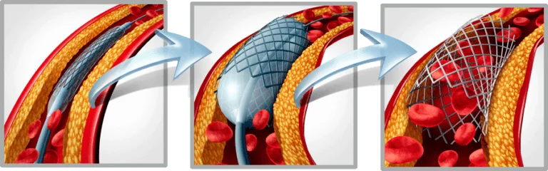 Implantacion stent