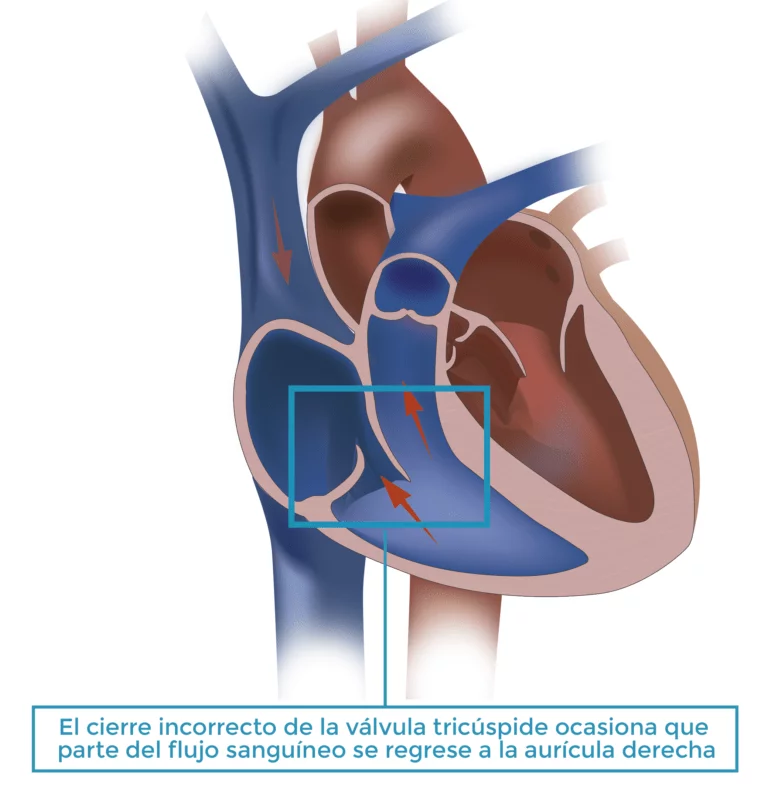 Valvula tricuspide con insuficiencia