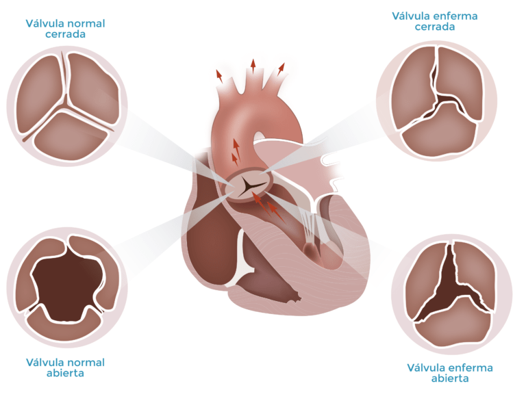 Valvula aortica