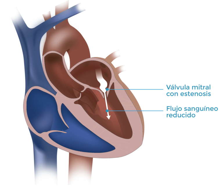 Estenosis de la valvula mitral