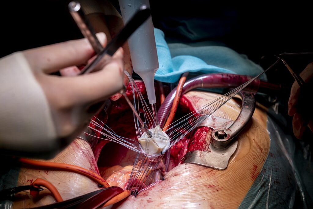 Cirugía de prótesis cardiaca