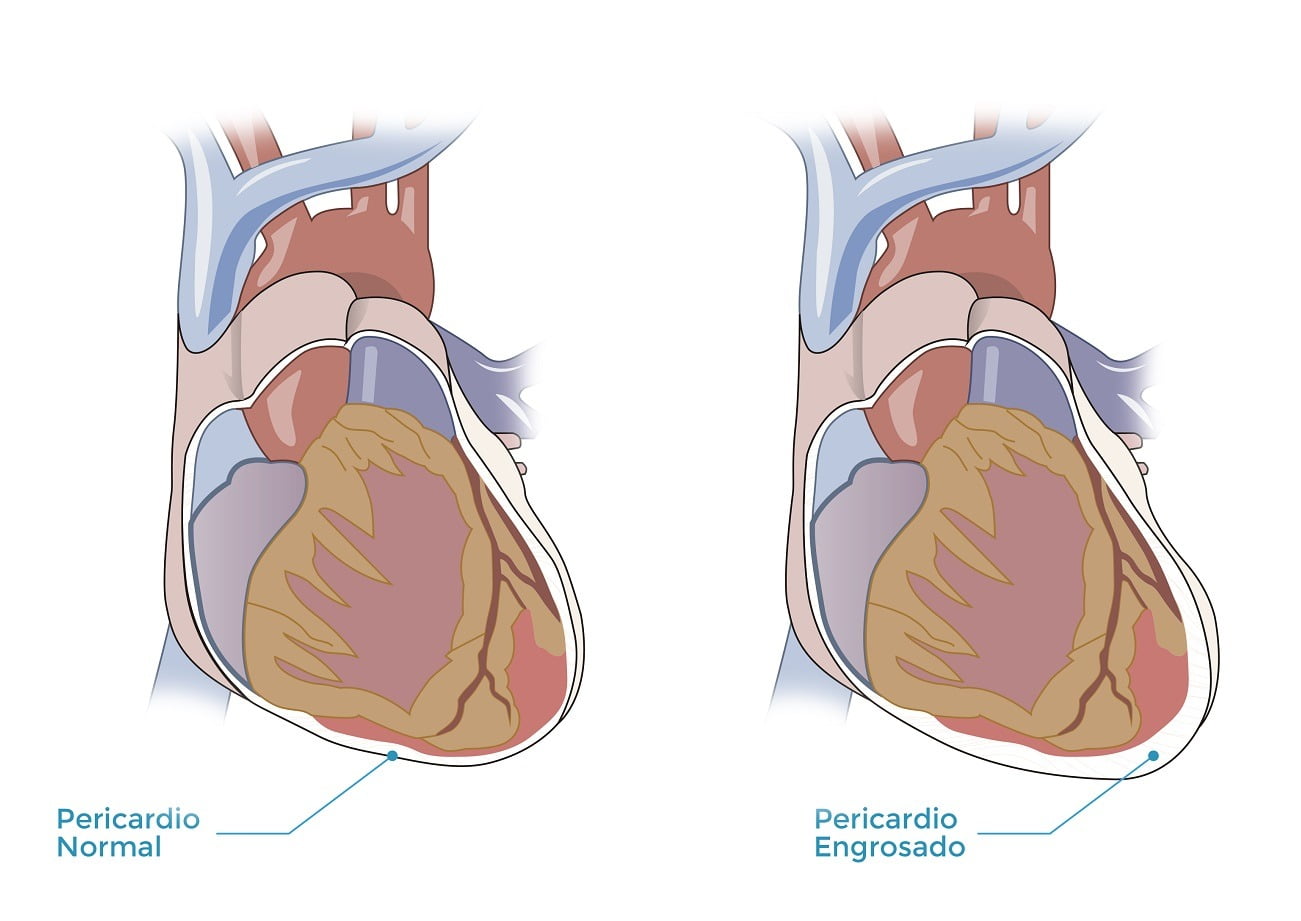 Cirugía del Pericardio - Unidad Cirugía Cardiaca Dr. Rodríguez