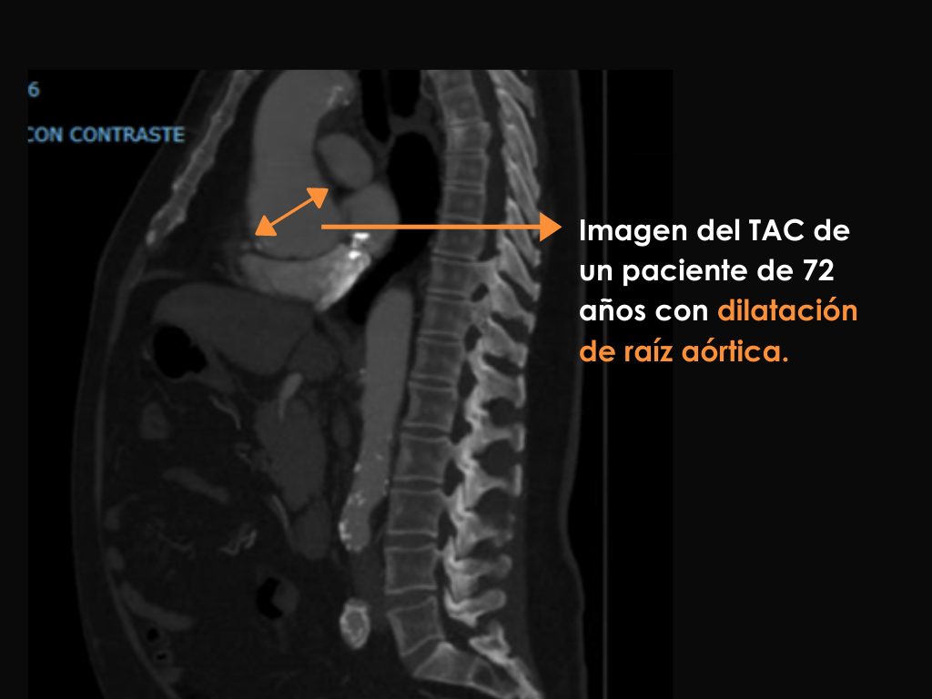 Aneurisma de aorta, imagen TAC